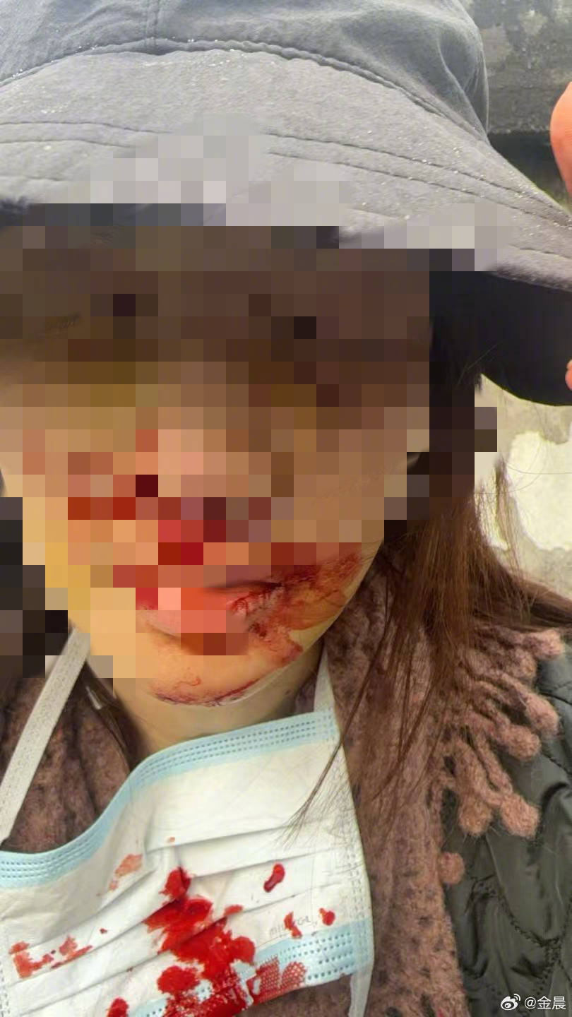 警方发布警情通报后<strong></p>
<p>虚拟币认筹</strong>，金晨晒脸部受伤照片并发文道歉