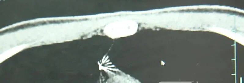 17岁小伙参军体检发现胸腔内有根5cm缝衣针<strong></p>
<p>pvc现货价格行情</strong>，父母回忆或是1岁时扎入，取出时已锈迹斑斑