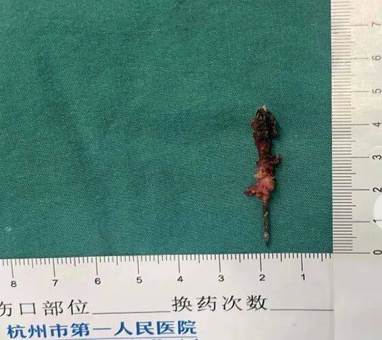 17岁小伙参军体检发现胸腔内有根5cm缝衣针<strong></p>
<p>pvc现货价格行情</strong>，父母回忆或是1岁时扎入，取出时已锈迹斑斑
